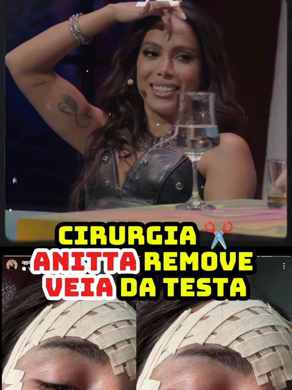 Anitta surge de curativo na testa e fãs reagem: 'Tirou a veia?'.  A cantora compartilhou uma foto em recuperação nos stories do Instagram. A cantora Anitta, de 31 anos, apareceu nesta terça-feira (10) com um curativo na testa. A cantora realizou, em Goiânia, um procedimento estético de retirada da veia frontal da testa. A funkeira sempre deixou claro que a veia a incomodava quando sorria. Em uma entrevista em junho deste ano, para um programa de televisão na Colômbia, ela destacou que pretendia fazer a retirada. Em muitas das declarações feitas sobre sua veia, Anitta contou seu incomodo. “Meu nariz já está bem, mas quando sorrio muito, salta essa veia que eu não gosto”, explicou no programa colombiano The Juanpis Live Show. “Quando sorrio fico com essa veia. Quando estou feliz, quando estou com ódio. Só quando não estou sentindo nada, aí não vem”, desabafou. No mesmo programada ela contou que já havia encontrado um médico para resolver o 'problema', mas não explicou com detalhes sobre qual tipo de procedimento irá realizar. Na web, os fãs declaram o fim de uma era. 