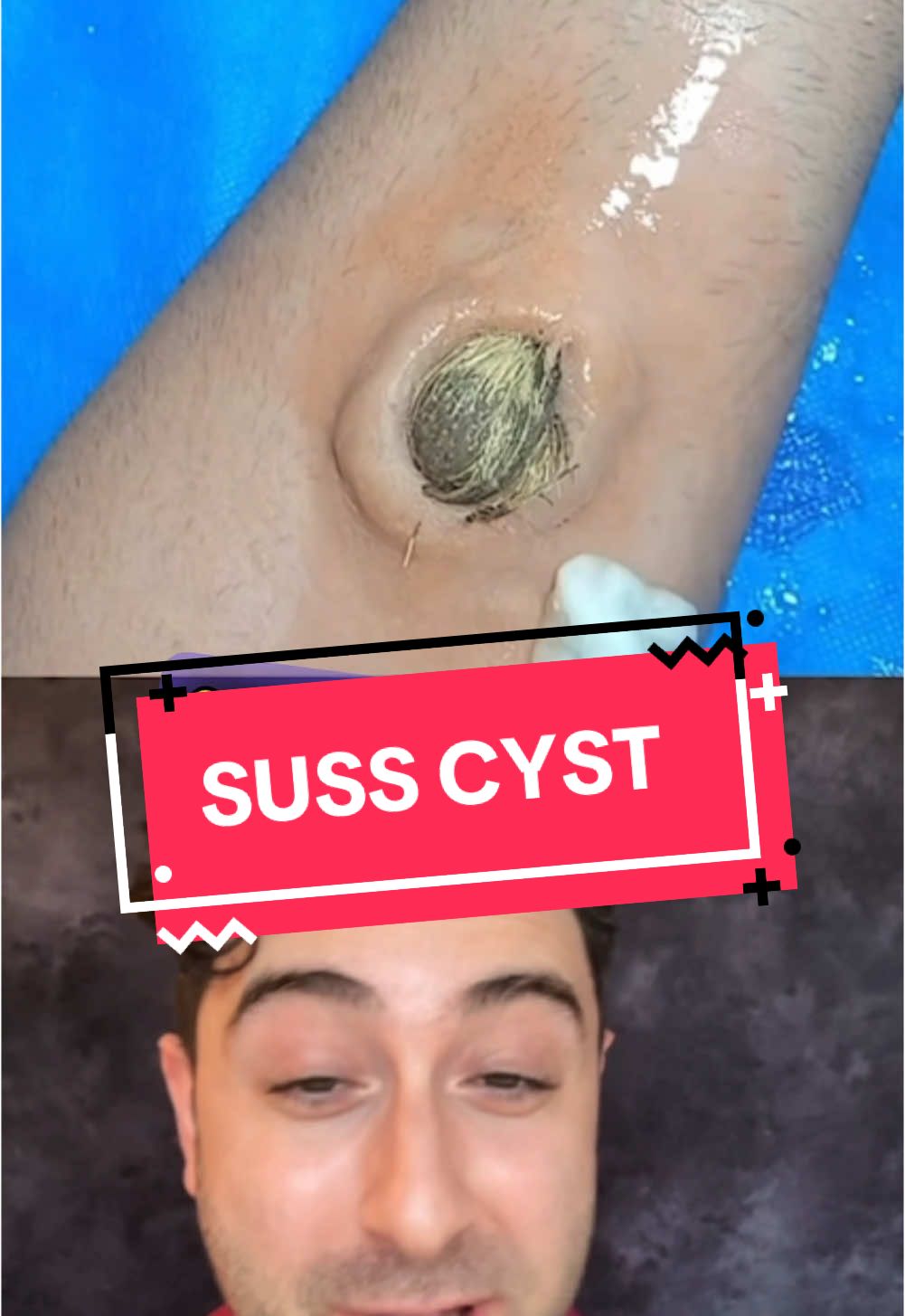#pimplepatch #pimpleremoval #pimplepopper #pimple #acnewarrior #blackhead #cyst #acne #skincare #pimplepopping 