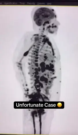 This is a terrible and unfortunate case of widely metestatic cancer. This was a PET scan looking for abnormal uptake anywhere else in the body. The dark black areas are cancer.. it is everywhere and in every organ.. including the bones. I am so sorry. #nurses #doctor #nurse #fyp #fypシ #doctorsoftiktok #nursesoftiktok 