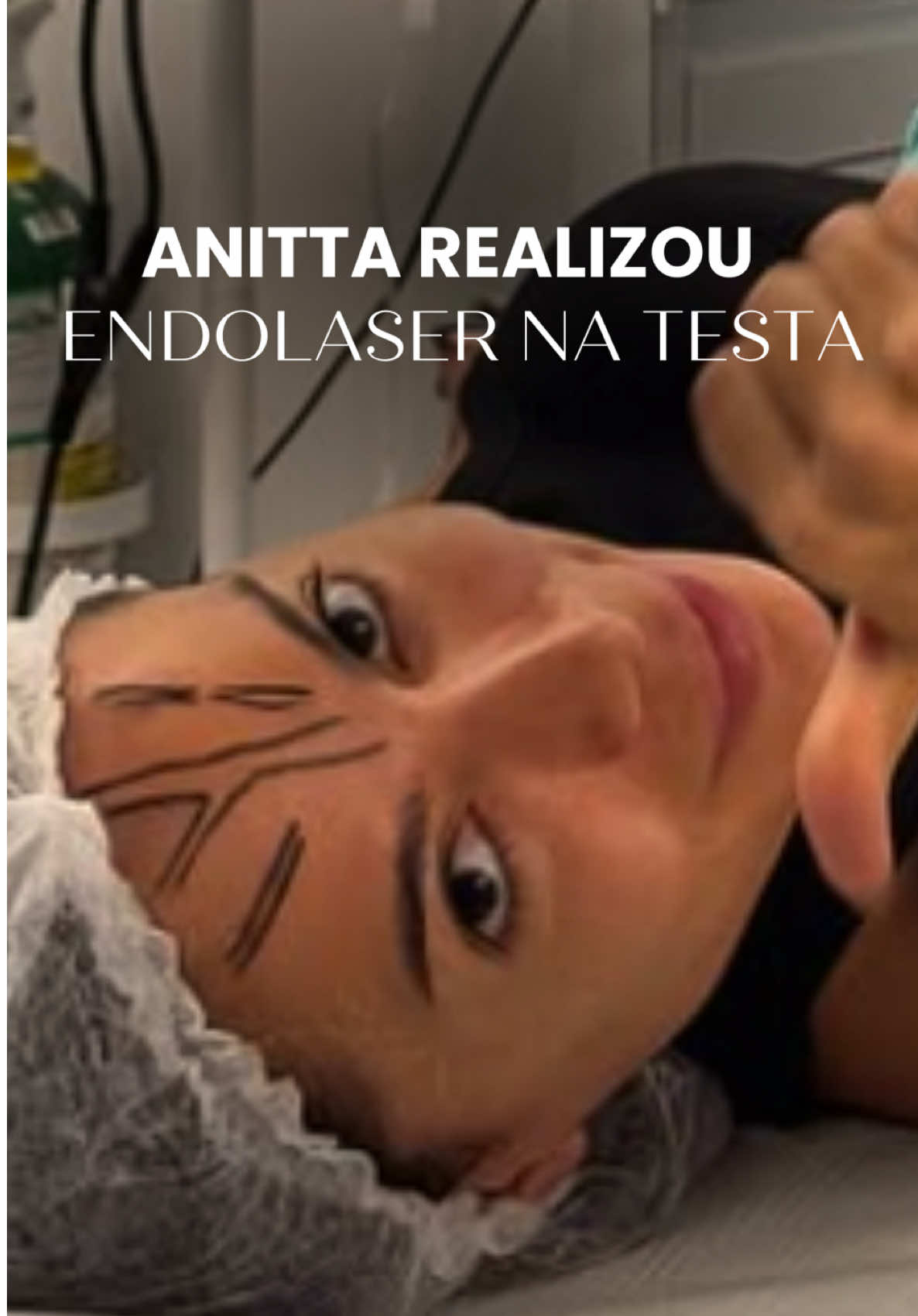 A cantora Anitta escolheu o endolaser para se livrar de uma veia na testa que a incomodava! 💉 Confira o vídeo para saber mais sobre esse tratamento!  #Endolaser #BelezaSemIncômodos #SaúdeVascular