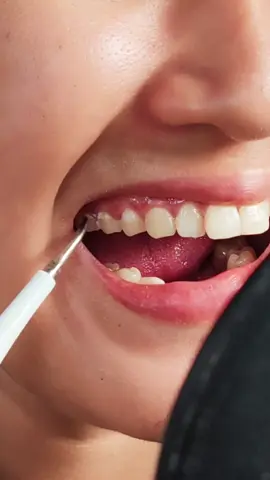 Kung may tartar yung mga ngipin mo, subukan mo itong Electric Teeth Cleaner. #electricteethcleaner #electrictoothbrush #teethcleaner 