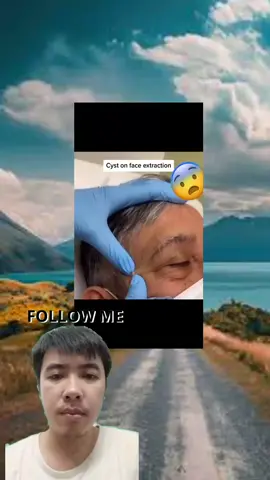 satisfying video cleaning #acne #pimple #pimples #blackhead #blackheads #treatment #extractions #cyst #popping #toenail #pedicure #callus #botfly #parasite #satisfying #satisfyingvideo #cleaning #cleaningtiktok #fyp