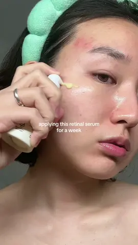 this retinal is perfect for acne prone skin girlies with extra sensitive skin❤️‍🔥 @KSECRET GLOBAL #retinal #retinol #acnescars #darkspots #acneskincare #kbeauty #fyp