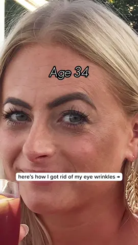 Here’s how I got rid of my eye wrinkles 😊 #microneedling #microneedlingface #wrinkles #finelines #antiaging #seekglo #microneedlingtherapy 