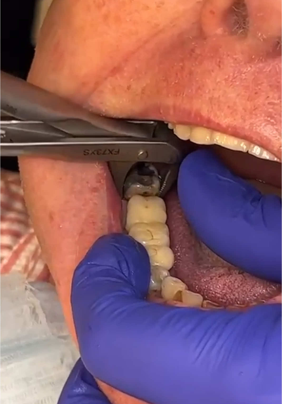 Lower molar extraction made easy. #dentistry #oralsurgery #dentist #teeth #surgery #جراحه_الوجه_والفكين #extraction #ليبيا_طرابلس_مصر_تونس_المغرب_الخليج 