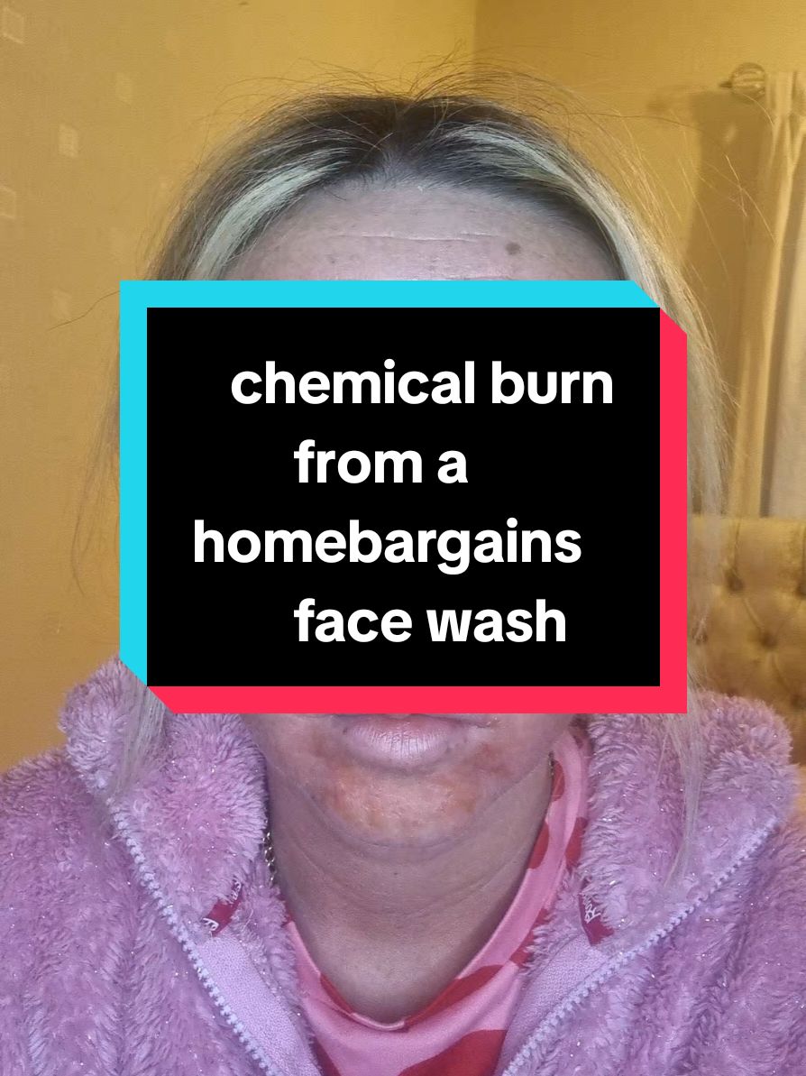 I feel devastated 😞 my face looks like a monster I feel ashamed to go out I'm in so much pain 😫 I just don't want this to happen to anyone else if you no someone with this product please tag them  #help #me #homebargains #burnt #skin #viralvideos #trendingvideo #fyp @In The Life Of @SmithsCaravangetaways2 @Home Bargains 