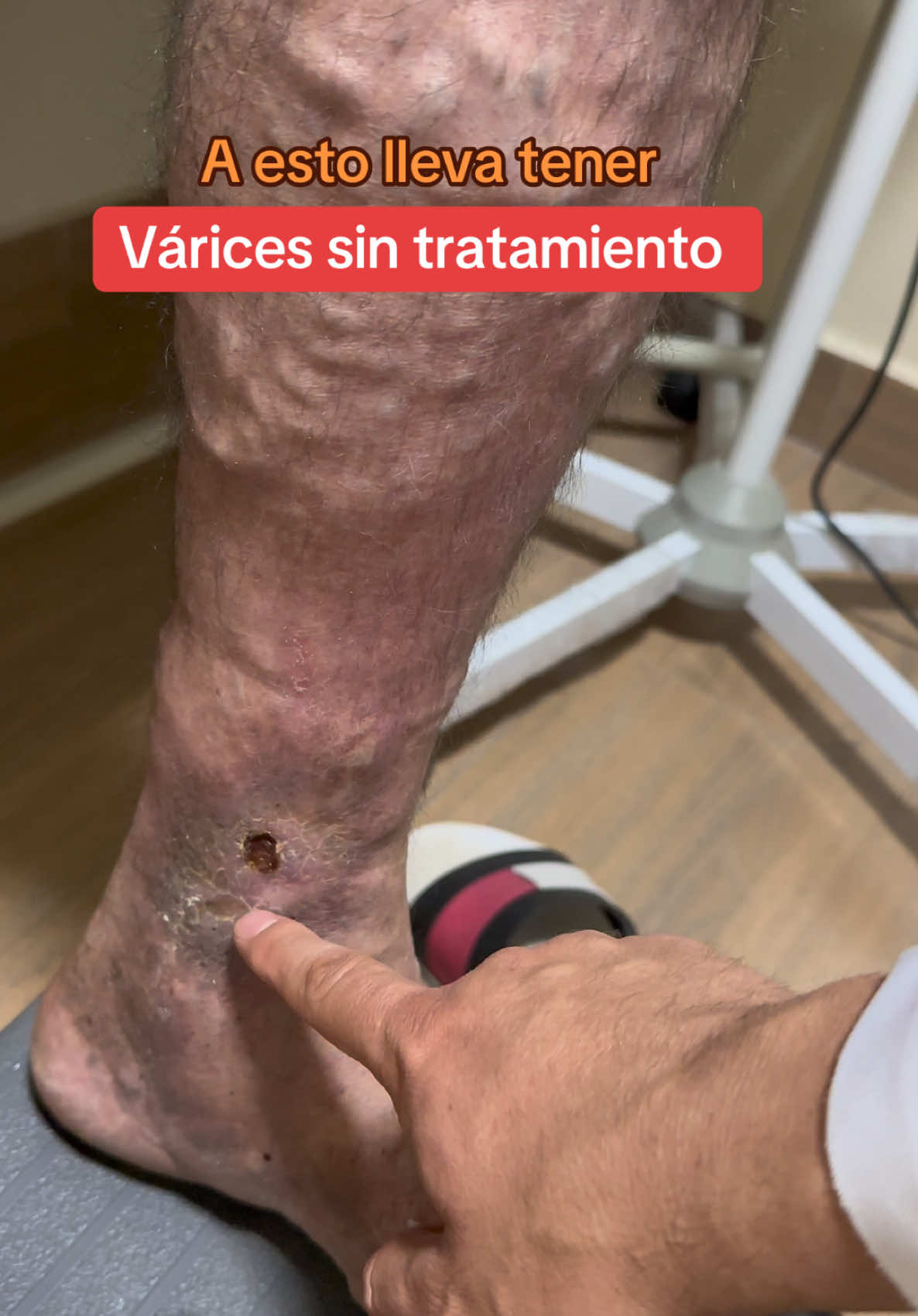 🏩 La Úlcera Varicosa 😨👆 es consecuencia de no tratar tus Várices a tiempo 🥹@The Vein Doctor 👨‍⚕️ Podemos ayudarte 👉 Ecuador - Riovasc - Riobamba 👈📲+593995178395/+593958757917 #varices #ulceravaricosa #ulceravenosa #varicesenlaspiernas #venasvaricosas #varicesyarañitas #arañasvasculares #cristianbravo148 #cirugiavascular 