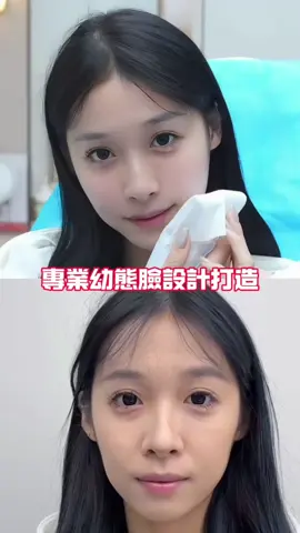 抗衰，幼態臉#幼態臉 #幼態 #醫美幼態 #輪廓固定 #幼态脸 #面部提升 