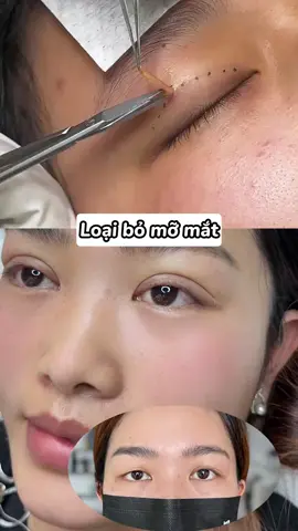 Loại bỏ mỡ mắt#mắthaimí #fyp #catmitunhien #mắt #PTTM 