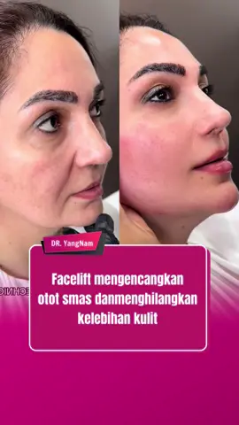 facelift di klinik YangNam #facelift #opfacelift #comesticsurgery #indonesia #malaysia #tiktokindonesia #dryangnam #fybシ 