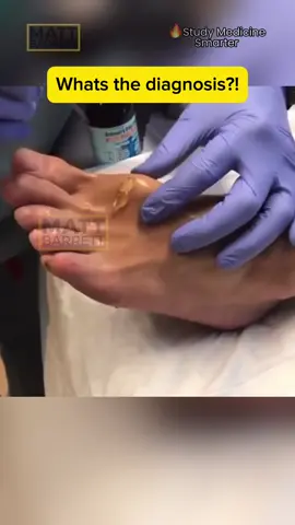 ⚠️ Tap here for the answer! ✅ Spoiler alert: Ganglion Here you can see a great big ganglion being expressed in the foot! Tendons attach muscles to bone. To help them glide with minimal friction, they typically travel in tendon sheaths.  These sheaths are lined with synovial fluid. If their integrity is disturbed then this fluid can accumulate into a mucoid/gelatinous mass called a ganglion! 💡They most commonly happen on the back of the wrist Usually they’re left alone to resorb by themselves 📕 In ye olde times they’d be struck with a heavy book to squish them (but they’ll likely come back later) 🔪 If particularly bothersome they can be surgical expressed like you’re seeing here! #doctor #nurse #medical #mbbs #medico #medstudent