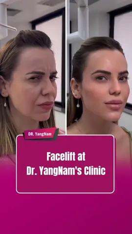 Facelift at dr Yangnam clinic #facelift #opfacelift #comesticsurgery #indonesia #malaysia #tiktokindonesia #dryangnam #fybシ 