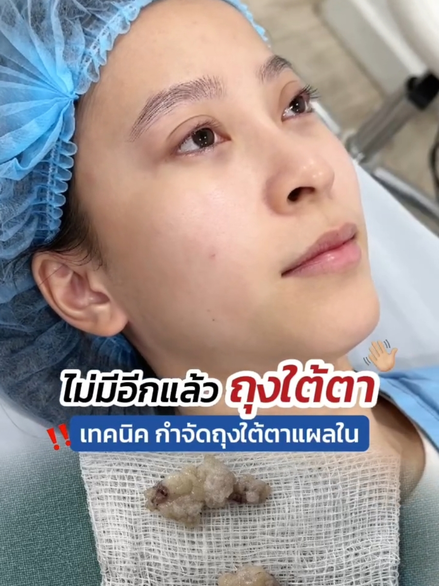บอกลา #ถุงใต้ตา หน้าโทรมไม่สดใส กับ #กำจัดถุงใต้ตา แผลใน #ทีมแพทย์หมอสกาย #สกายคลินิก #skyclinic  #ตัดถุงใต้ตา #ศัลยกรรมตา #จักษุแพทย์ #ทําตาที่ไหนดี #คลินิกทําสองชั้น #รีวิวตาสองชั้น #รีวิวบิวตี้ 