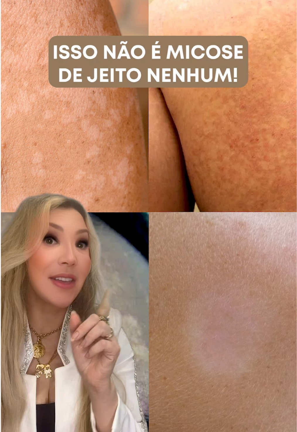 Isso não é micose! Pode ser pitiríase alba. Aquela mancha esbranquiçada na pele, geralmente no rosto ou nos braços, é algo que muitas pessoas confundem com micose. Mas, na verdade, pode ser pitiríase alba, uma condição dermatológica comum em crianças e adolescentes. Ela aparece como manchas claras e ásperas, principalmente em peles ressecadas, e não é causada por fungos. Na maioria das vezes, é resultado de uma dermatite leve que acaba deixando a pele mais clara naquela área. Para tratar, é importante hidratar a pele com cremes específicos, pois a hidratação ajuda a suavizar as manchas e recuperar a barreira da pele. Usar protetor solar diariamente também é indispensável, já que o sol pode destacar ainda mais as áreas esbranquiçadas. Além disso, evitar coçar ou aplicar produtos irritantes é fundamental para não piorar o quadro ⚠️ Lembre-se: é sempre importante consultar um dermatologista para confirmar o diagnóstico e receber orientações personalizadas. Já percebeu alguma manchinha parecida?  #cuidadoscomapele #dermatologia #pelebonita #hidratação #protetorsolar #pitiríasealba #viral 