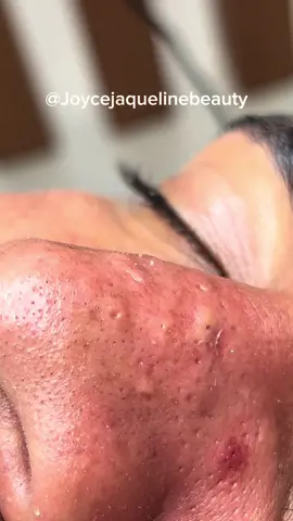 Vai um creme branco aiii?? 🤭🤣 #foryoupage #fy #satisfyingvideo #tirandocravo #limpezadepele #poppingpimples #pimple 