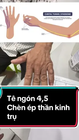 Tê ngón 4,5 do chèn ép thần kinh trụ tại khuỷu tay #tetay #tebantay #benhvienchanthuongchinhhinh #khopvietofficial #bacsichanthuongchinhhinh #bsnguyenviettan #bscoxuonhkhop @BS.CK2. Nguyễn Viết Tân 