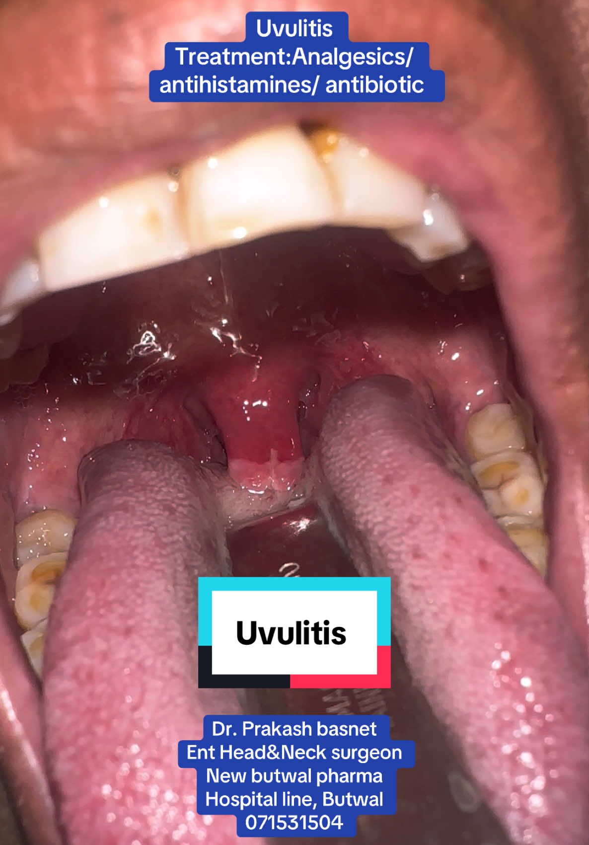 #uvulitis #foryou #viral #trending #fyp #entdoctorbutwal #ent #fypシ゚viral 