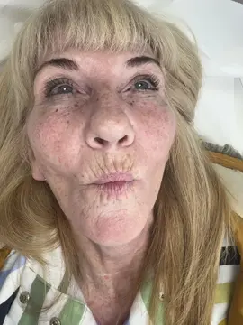 💉Smokers lines anti wrinkle… dramatically de-ages your lower face, and reduces the appearance of upper lip lines which we call (smokers lines) static lines are tricky to remove fully but as you can see the difference between the before & afters is fabulous! 🫶🏼💉 a really popular treatment.. 💫