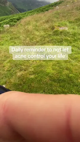 Daily reminder to not let acne control your life 🫶🏼 #acnepositivity #dailyreminder 