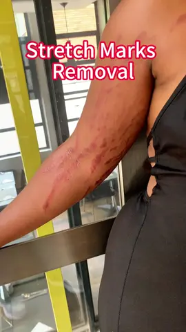 Get rid of those annoying scars and regain your smooth skin. You won't regret it! #scarremoval #TikTokBeauty #healing #skincare #effectiveproducts #tiktokshopblackfriday #blackfriday