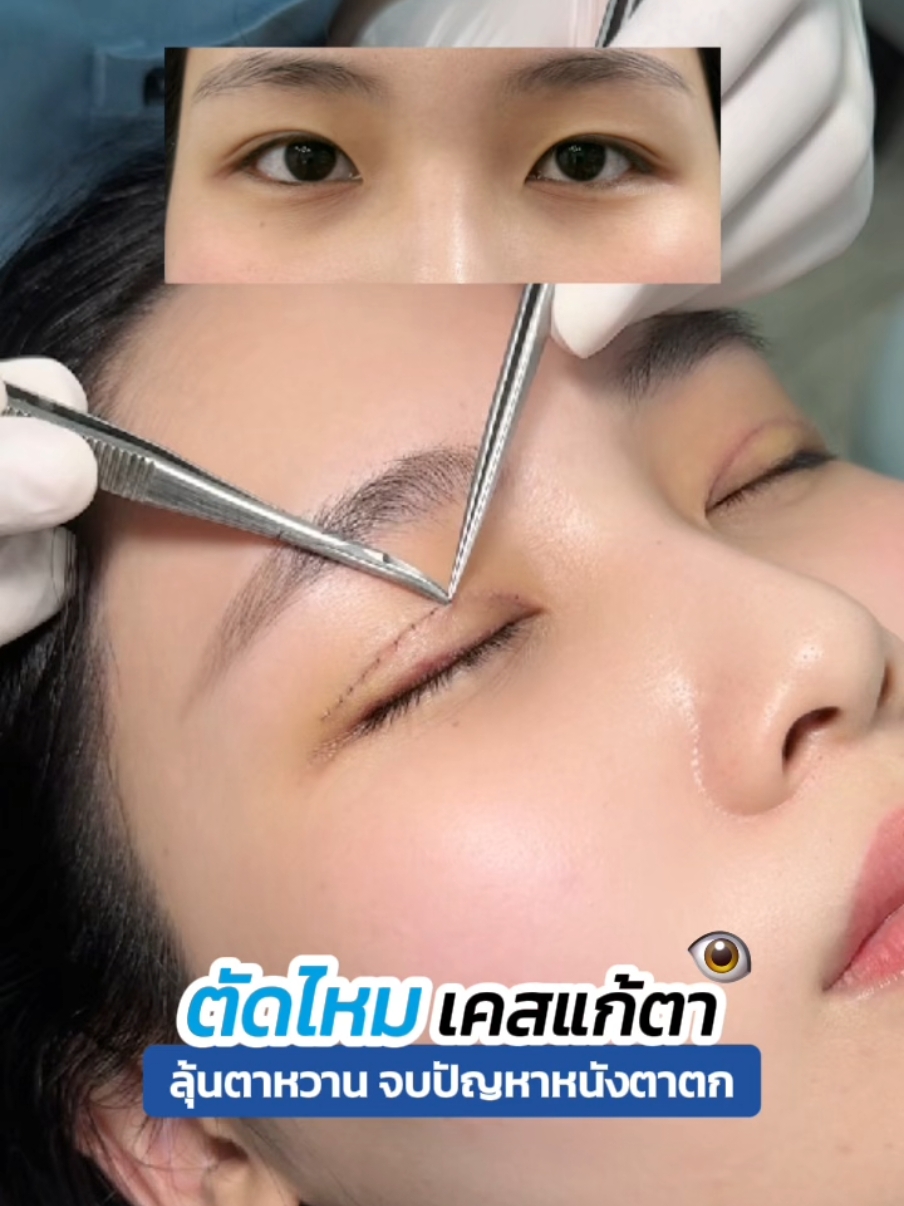 ตัดไหม #เคสแก้ตา จยปัญหาหนังตาตก ✂️✨️ #หมอสกาย #สกายคลินิก #skyclinic #จักษุแพทย์ #ทําตาที่ไหนดี #รีวิวตาสองชั้น #คลินิกทําสองชั้น #sweeteyes #ศัลยกรรมตา 