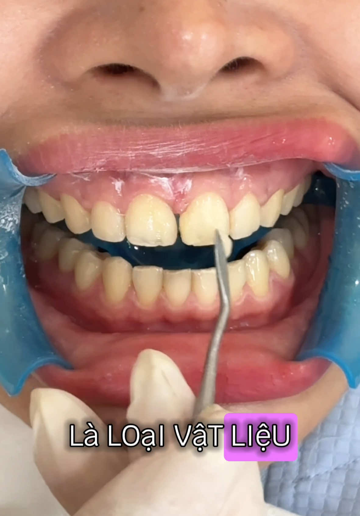 Cận cảnh trám thưa răng cửa 🦷🦷 #trám_răng_thưa #trámrăng_sứt_mẻ #trám_răng_sâu #composite #đắp_răng_khểnh #răng_khểnh #yfp #xh #hottrend #tiktokviral #làmđẹp #nụcười 