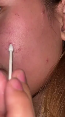 #icelerskin #acnetreatment #fyp #foryou 