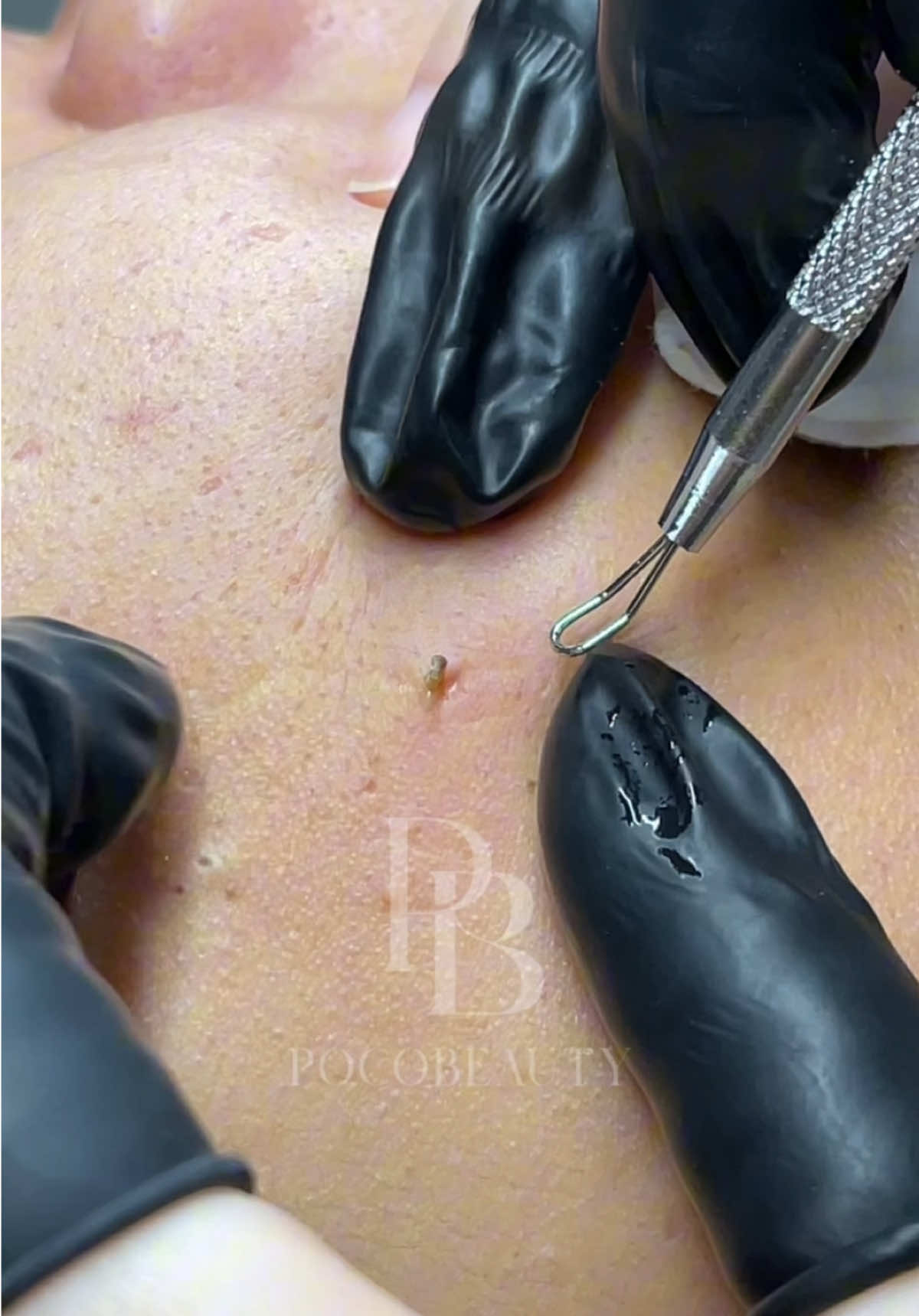 20 YEARS OLD BLACKHEAD! 😱 Adding another pop to our fav list! #sgfyp #sgfyp #fyp #viralsg #viralsg #sgbeauty #sgpimplepopper #pimplepoppersatisfying #blackheadsremoval #blackhead #pimplepopperaddict #pimplepopper #pimplepop #pimplepopping #blackheads #blackheadpopping #facial #facialtreatment