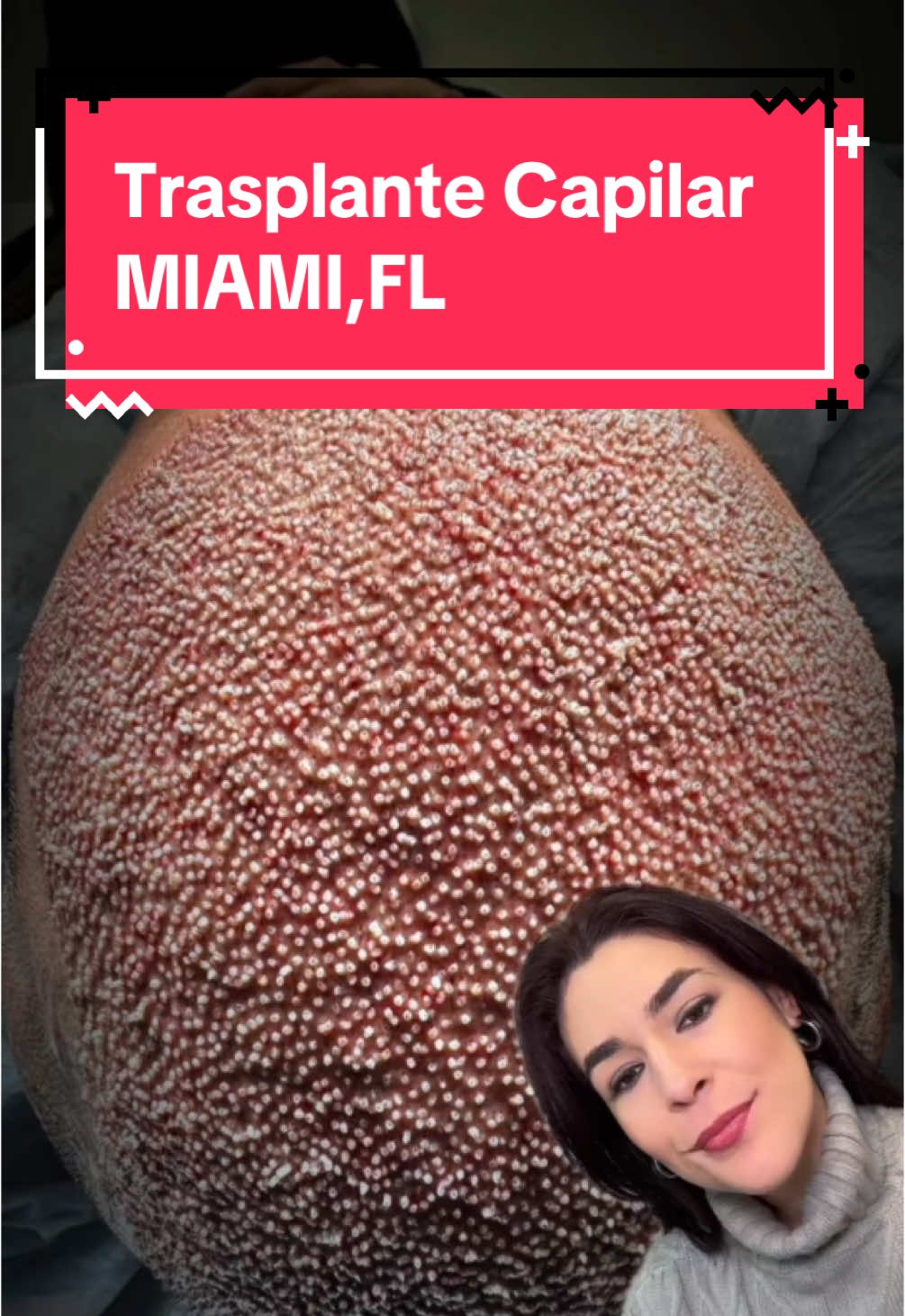 Hoy compartimos contigo esta forografía de uno de nuestros #pacientes Nosotros utilizamoa anestesia local y no sentirás dolor durante el peocedimiento. Para más información escríbenos un mensaje directo y obten asesoramiento en línea y #gratis #hairtransformation #hairtransplant #trasplantecapilar #miami #miamifl 