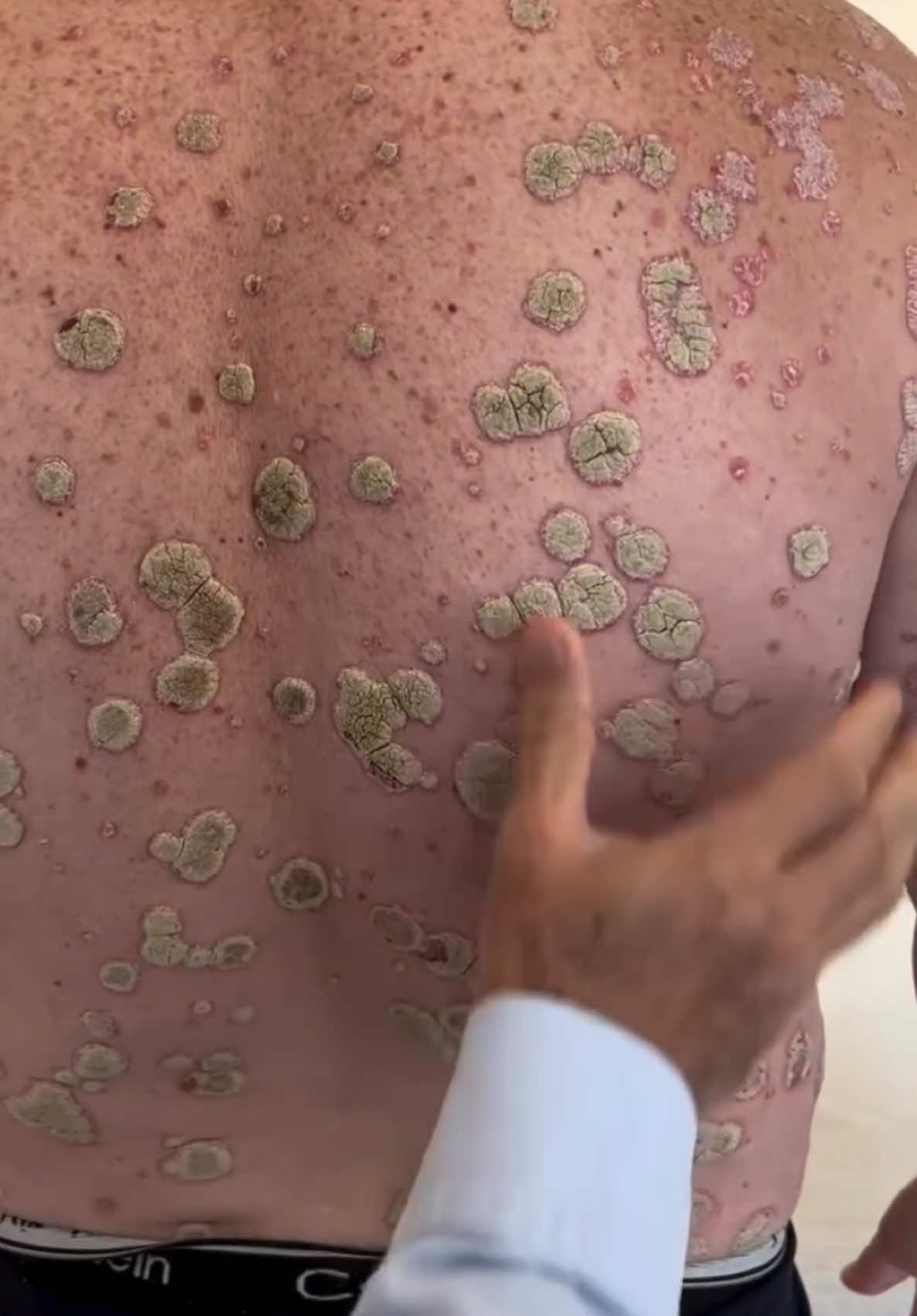 📢 Did you know your skin is the largest organ and a powerful detoxifier? Plaque psoriasis isn’t just skin-deep—it’s a signal of inflammation and toxins in the body. 🌿 Dive into the root causes and discover how holistic healing can make a difference! 💡 #PsoriasisAwareness #DetoxYourBody #NaturalHealing