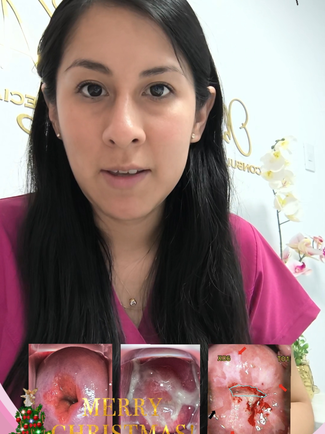 Respuesta a @fernandaparraga12 CERVICITIS O ECTOPIA CERVICAL #cervicitis #cervicitiscronica #cervicitisaguda #cervicitisinfecciosa #ectopiacervical #ectopia #ectropion #ectropioncervical #herida #heridadecuellouterino #cancerdecuellouterino #cuellouterinoinflamado #cuellouterinorojo #vph #pruebavph #segundaopinion #consultavirtual #obstetraespecialista #femprev #vmt #villamariadeltriunfo #nuevaesperanza #sjm #sanjuandemiraflores #villaelsalvadorlimaperu #ves #josegalvezvmt #surco #chorrillos #lurin #pachacamac #limasur #limaperu🇵🇪 