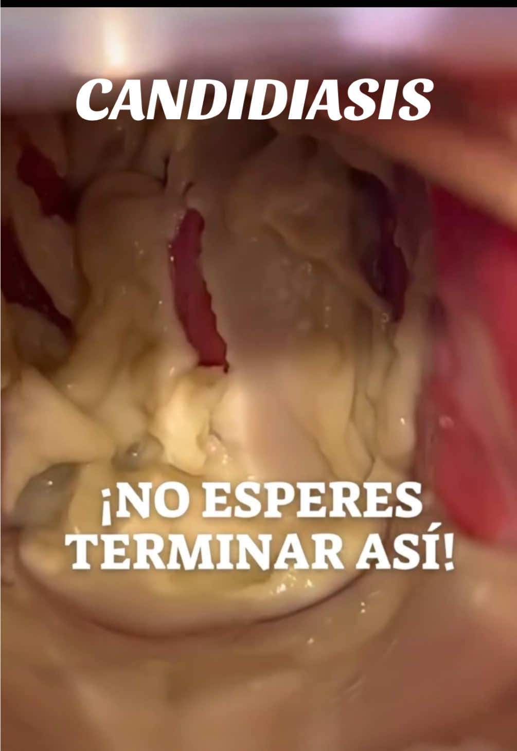 #candidiasis #cervicitis #viralvideos #greenscreen #paratiiiiiiiiiiiiiiiiiiiiiiiiiiiiiii 