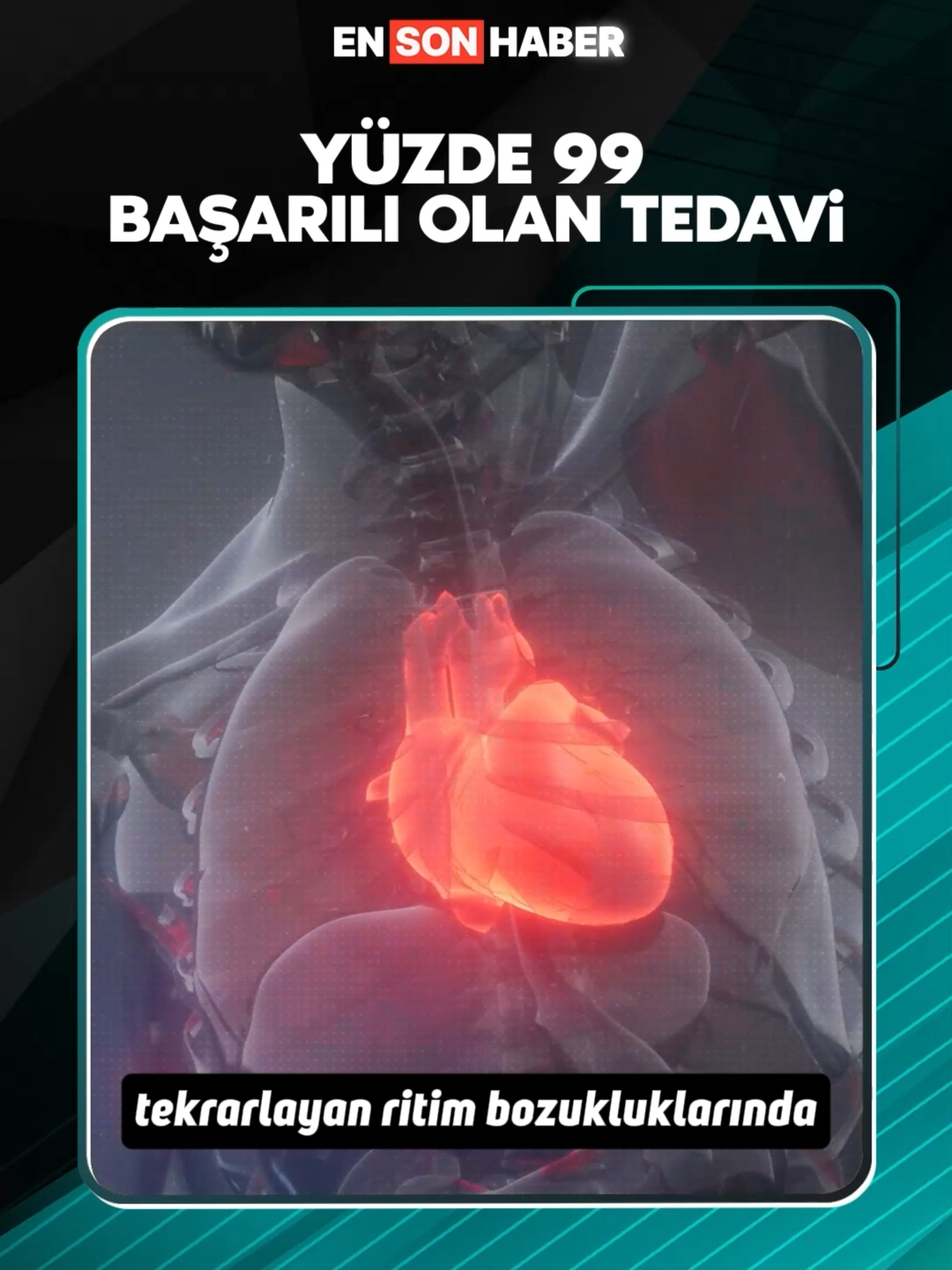 Medipol Sağlık Grubu Kardiyoloji Uzmanı Prof. Dr. Dursun Aras, kalp ritim bozukluğu yaşayanların yapması gerekenleri ve tedavi yöntemini anlattı.  #sağlık #kalp #tedavi #doktor #tavsiye
