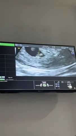 Sáng nay đi siêu âm em bé có tim thai chưa nè ❤️ nhả vía tim thai rộn ràng cho các mom. Bám mẹ chắc nhé bố mẹ yêu con 👼🏻 #vochongson #ty2025 #sanbena #hanhtrinhdonembe #hanhtrinhlamme #xh 