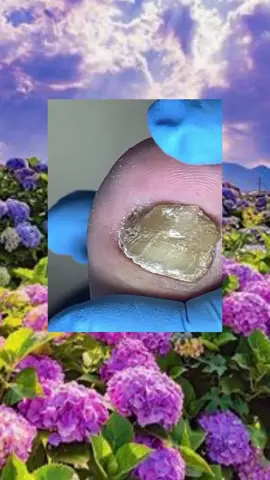 #toenails #ingrowntoenail #toenailremoval #nails #toenail #satisfyingvideo #fyp