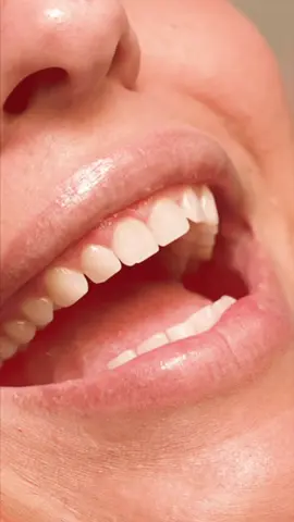 No prep, no teeth shaving porcelain veneers before and after. #noprepveneers 