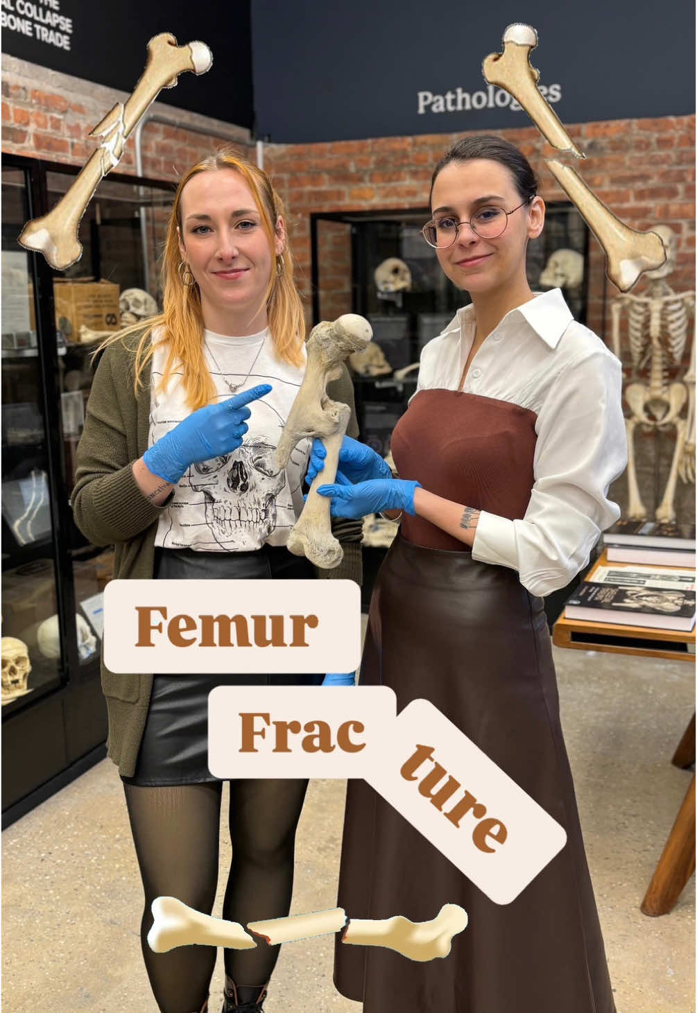 Dynamic duo alert! 🔥 Masha and Paige break down (pun intended) the science behind this shattered femur 🦴. The femur, the strongest bone in the human body 💪, doesn’t break easily—but when it does, the results can be dramatic. A comminuted fracture shatters the bone into multiple pieces, while an oblique fracture slices through the bone at an angle, making treatment especially challenging 🩺. Bone healing is an intricate process: first, the body forms a hematoma 🩸 to stabilize the break and initiate repair. From there, a soft callus begins to form, which slowly hardens into a bony callus over several weeks ⏳. Finally, the remodeling phase refines the structure, restoring strength and function 🛠️. This type of fracture is a striking example of the challenges faced by the skeletal system—and a testament to its remarkable ability to heal 🌟. Curious to learn more? Watch the full video! 🎥✨ #bonetok #osteology #forensics #bonemuseum 