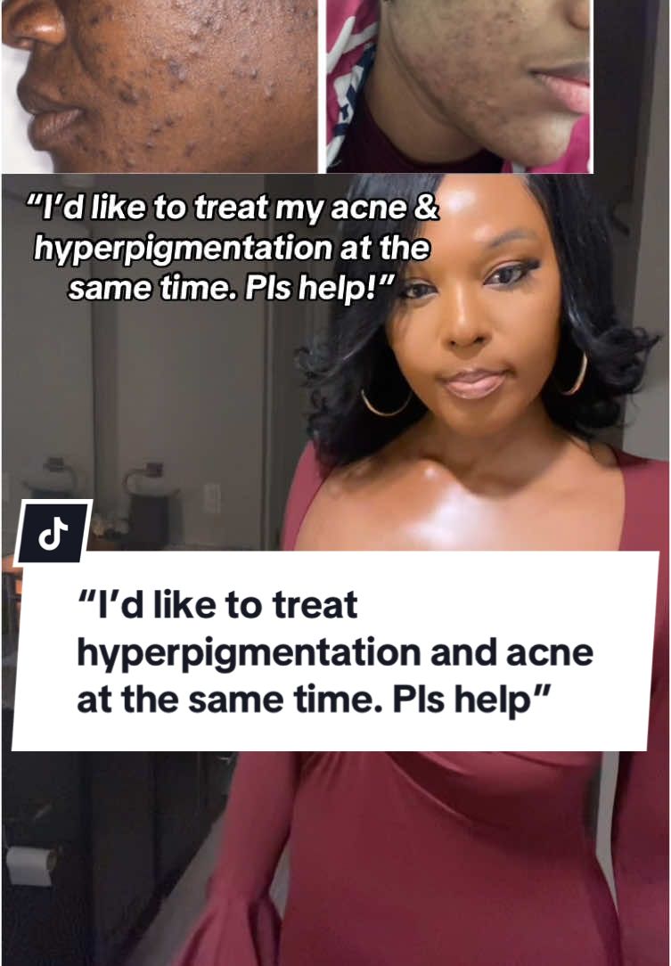 Expect results in 1-3 months. Happy Sunday😊💕 - #acne  #hyperpigmentation 