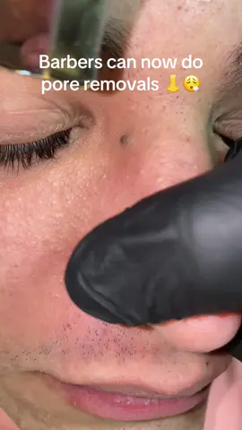 Pore scraping, using tools like a pore spatula, offers several benefits including deep cleansing by removing dirt, oil, and blackheads, which helps reduce congestion and prevent breakouts. It gently exfoliates dead skin cells, improving skin texture and promoting a smoother, brighter complexion. Clearing out debris minimizes the appearance of pores and enhances the absorption of skincare products. The process also stimulates circulation, contributing to healthier, glowing skin. When used correctly, pore scraping is a non-invasive method that supports overall skin clarity and refinement. #satisfying #oddlysatisfying #skincare (Compilation of videos from mahmoudgamalsalons/tt)