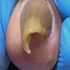 The extra Long and curled Nail #trending #trendingvideo #toenail #pedicure #修脚 #naildesigns #ingrowntoenail #ingrownnail #nailart #nail #nails #nailtutorial #fungusnailstreatment #nailsartvideos #fungusnails #fungus #toenails #móng