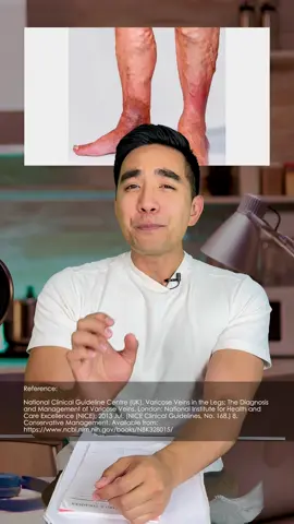 Paano iwasan ang Varicose Veins 