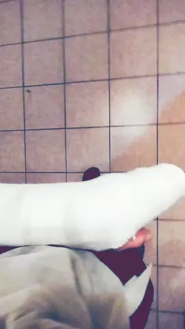 I have a hockey stick. 💪🥳.  #fyp #armcast #gips #cast 