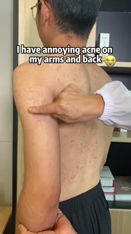 I have annoying acne on my arms and back#acne #bodywash #bodycare #body #fyp #skin #quarxery #mite #mites #foryou #foryoupage #bacne
