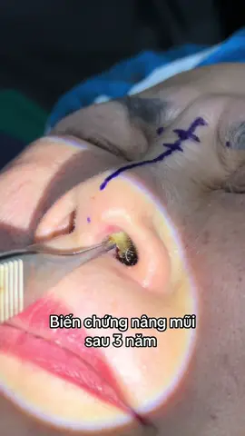 #nangmui #xuhuong #bsphamhao #suamuihong #gheptrungbi #lamdep 