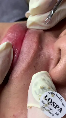 Ngứa o #chamsocdamun#chamsocdaseo#chamsocdanam#tanbinh#govap #Lequynh#Lqspa#hocnghespa  #chamsocda #lequynhspa #lequynhspahcm#vienthammylqspa#lqspabeautyacdemy#LQSPALQSPA