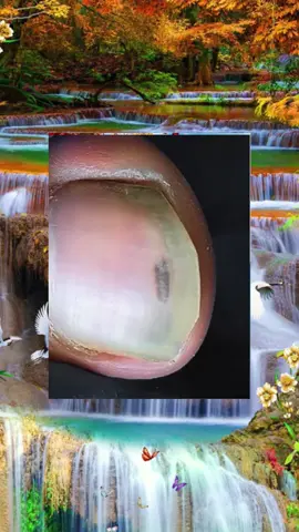 #toenails #ingrowntoenail #toenailremoval #nails #toenail #satisfyingvideo #fyp