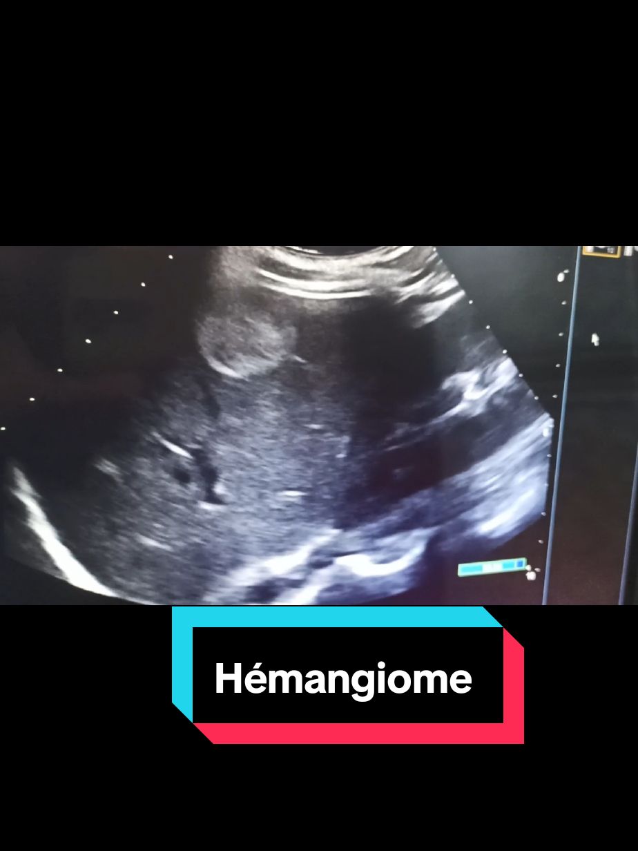 Échographie abdominale: hémangiome caverneux hépatique #echographie #ultrasound 