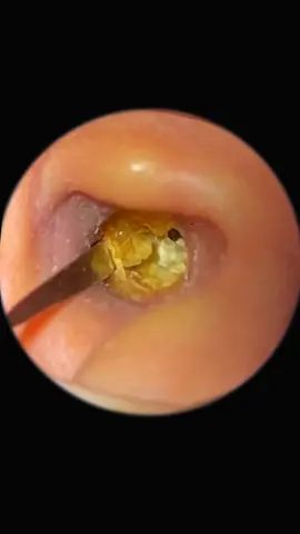 #earwaxremoval #earwax #relaxingvideos #relaxing #ear