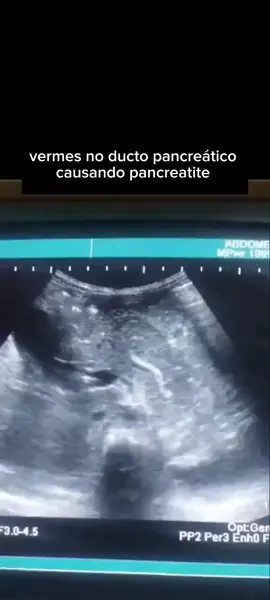 vermes no pâncreas  #fypage #saude #pancreas#diabetes#desparasitacaocompleta 
