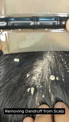 Her scalp is full of dandruff.. let's clean her up #scalpcare #dandruffremovel #hairtok #foryou 